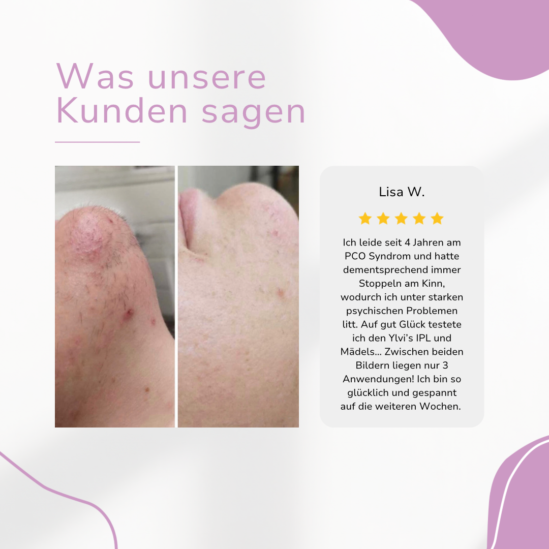 THARAH IPL Hair Remover I Die führende Laser-Haar-Entfernung für Zuhause