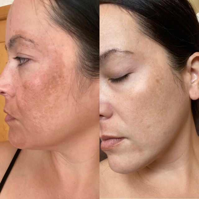 THARAH LED Licht Therapie Maske