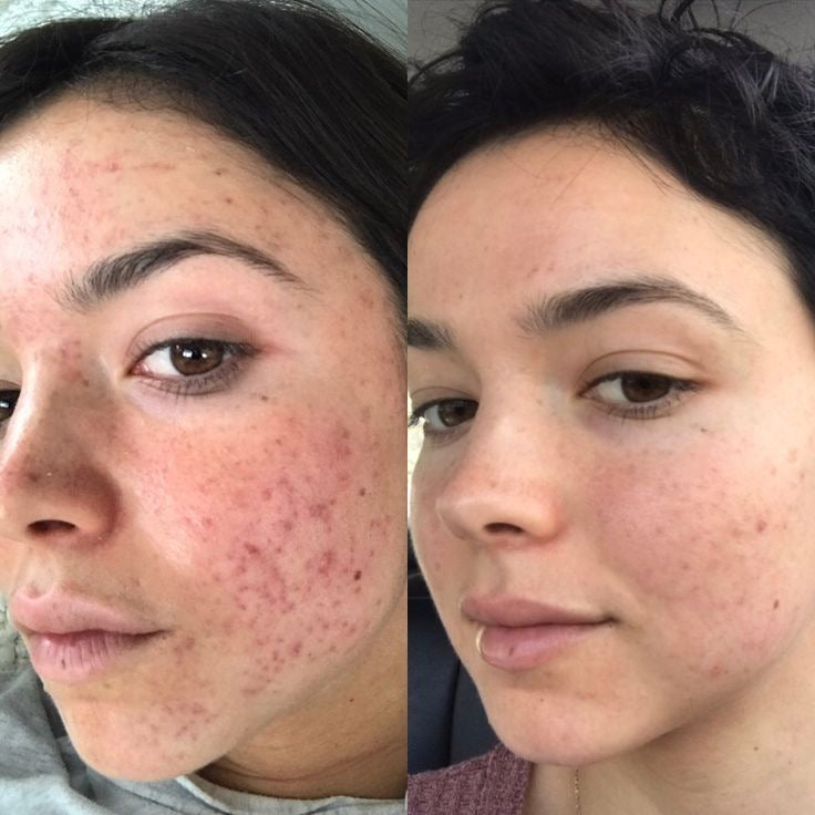 THARAH LED Licht Therapie Maske